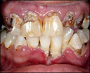 meth_teeth_rotten_2.jpg