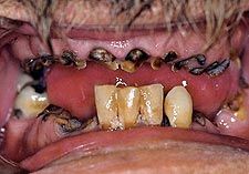 meth_teeth_rotten_3.jpg