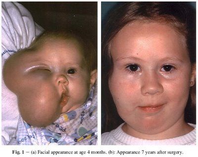TERATOMA.jpg