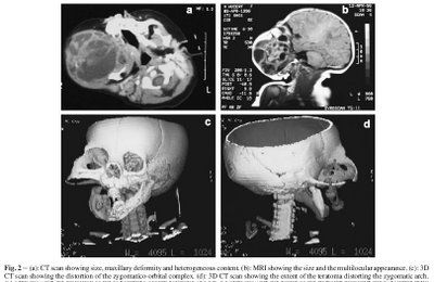 TERATOMA1.jpg