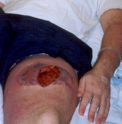 spiderbite.jpg