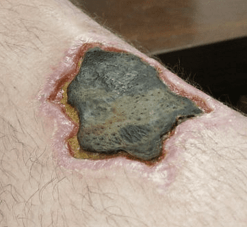 Necrotic_leg_wound.png