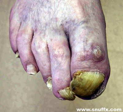 snuffx-dot-com-nailfungus.jpg