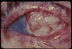 eye-cancer-3.gif