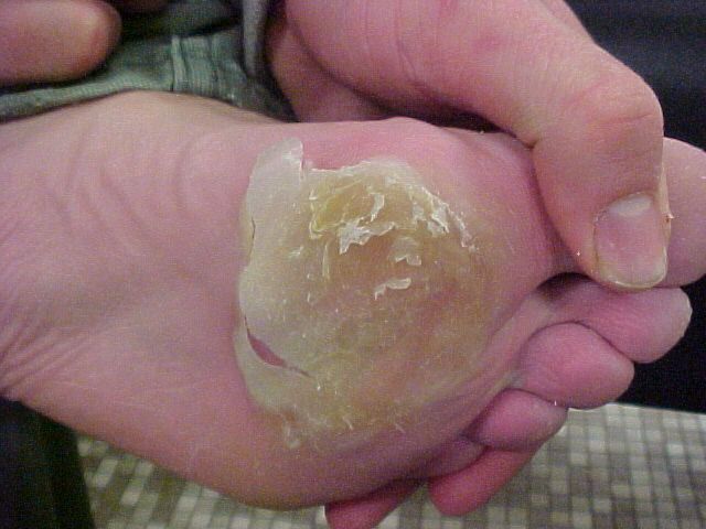 blister_JPG.jpg