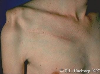 shoulder%20dislocaton_jpg.jpg