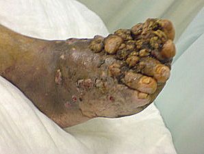 granuloma4.jpg