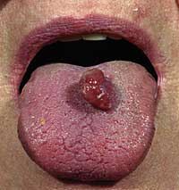 granuloma5.jpg
