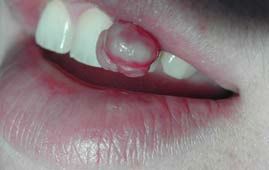 granuloma_teleang.jpg