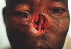nosecancer6.jpg
