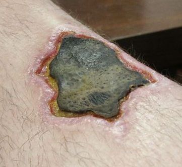 Necrotic_leg_wound.jpg