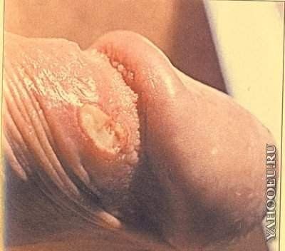 Sexually Transmitted Infections and Skin Conditions: Herpes and Syphilis - 1d880d614d53