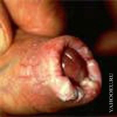 Sexually Transmitted Infections and Skin Conditions: Herpes and Syphilis - 16cddd318a88