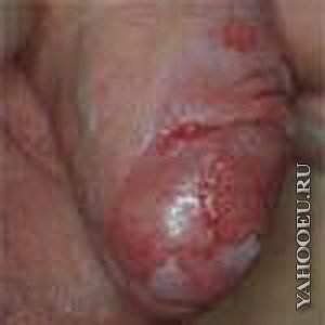 Sexually Transmitted Infections and Skin Conditions: Herpes and Syphilis - 773b59fe6233