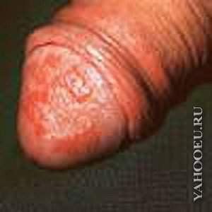 Sexually Transmitted Infections and Skin Conditions: Herpes and Syphilis - 11709cb60721
