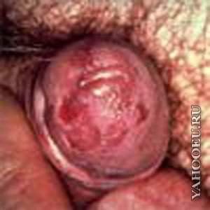 Sexually Transmitted Infections and Skin Conditions: Herpes and Syphilis - eb401d4975c3
