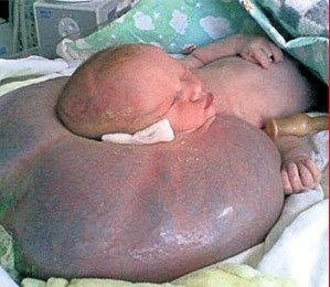 hugetumour.jpg