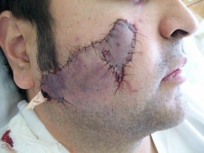 Name:  face 1 week after.JPG
Views: 908
Size:  31.4 KB