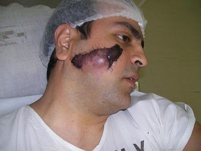 Name:  face 1 week after1.JPG
Views: 1001
Size:  20.5 KB
