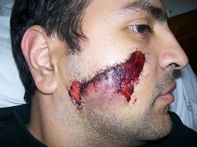 Name:  face 1 week after2.JPG
Views: 914
Size:  38.2 KB