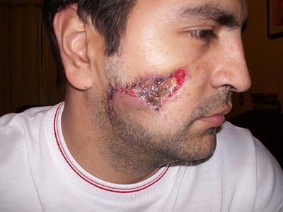 Name:  face month after.JPG
Views: 909
Size:  25.1 KB