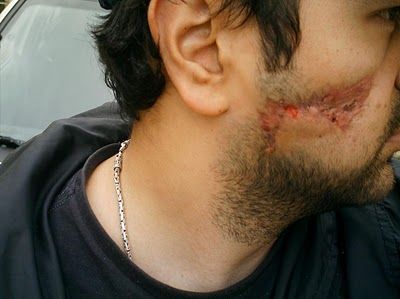 Name:  face 3 month later.JPG
Views: 906
Size:  23.5 KB