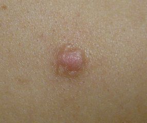 keloid2.jpg