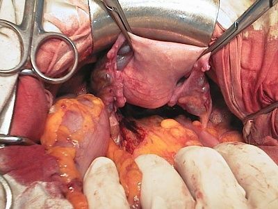rectal-cancer.jpg