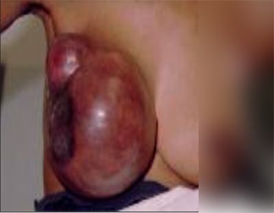 breast_cancer.jpg