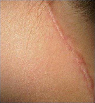 scar3.jpg