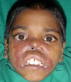 Lupus Vulgaris2.jpg