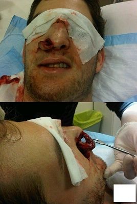 fucked-up-nose.jpg