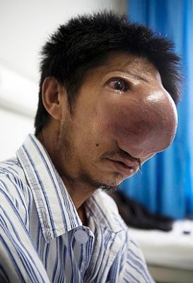 rt_nose_tumor_100824_ssv.jpg