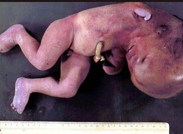 deformedfetus.jpg