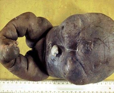 deformedfetus1.jpg