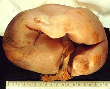 deformedfetus2.jpg