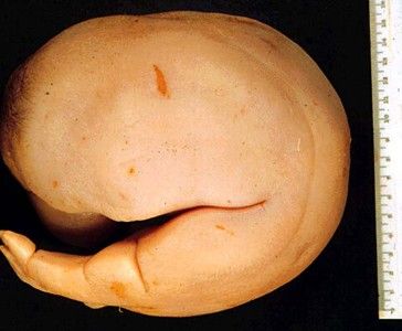 deformedfetus3.jpg