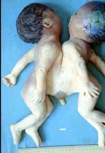 deformedfetus4.jpg