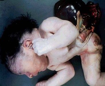 deformedfetus5.jpg