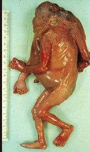 deformedfetus6.jpg