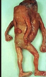 deformedfetus7.jpg
