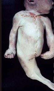 deformedfetus11.jpg
