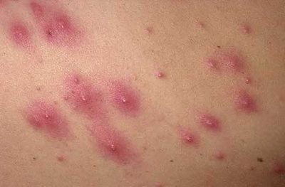 09pseudofolllesions.jpg