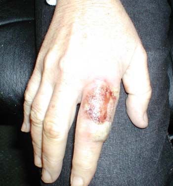 brown_recluse5.jpg