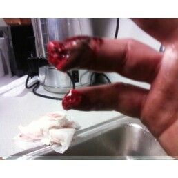 pully-injury.jpg