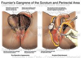 testicular gangrene.jpg