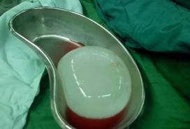 hydatid cyst.jpg