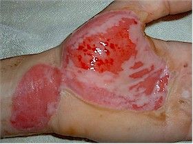 second degree burn 2.jpg