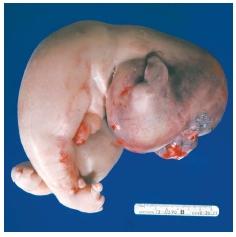 TRAP fetus2.jpg