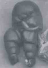 acardius_fig1.jpg
